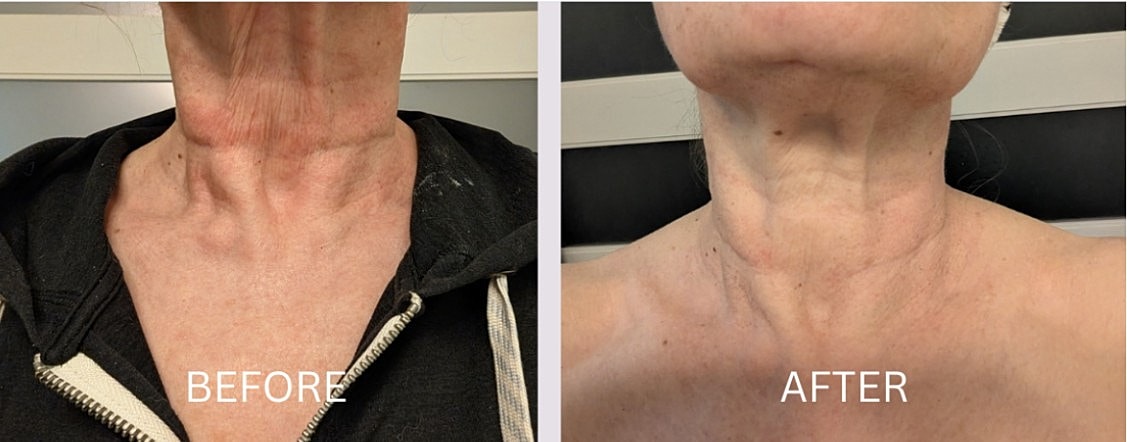 Neck rejuvenation before and after treatment comparison.