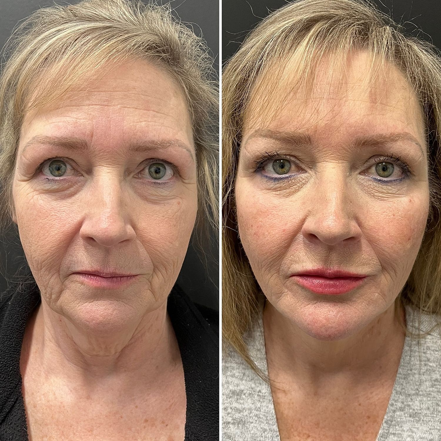 Before and after cosmetic enhancement results.
