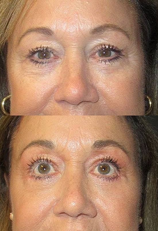Before and after cosmetic eyelid treatments comparison.