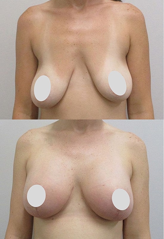 Before and after breast enhancement comparison image.