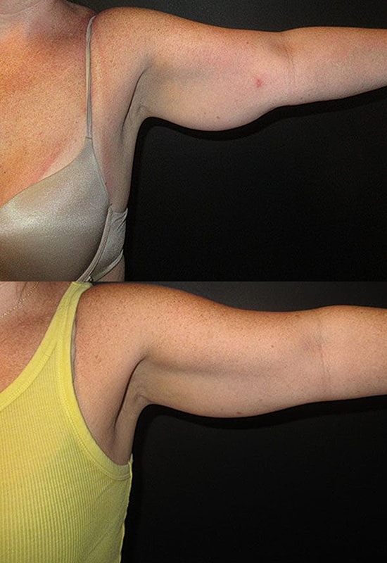 Before and after arm appearance comparison.