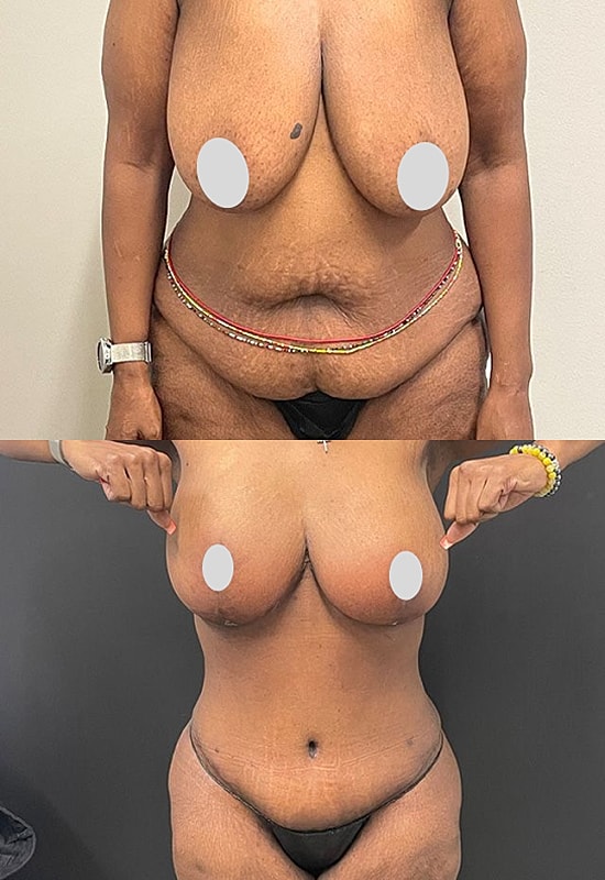 Before and after body transformation comparison.