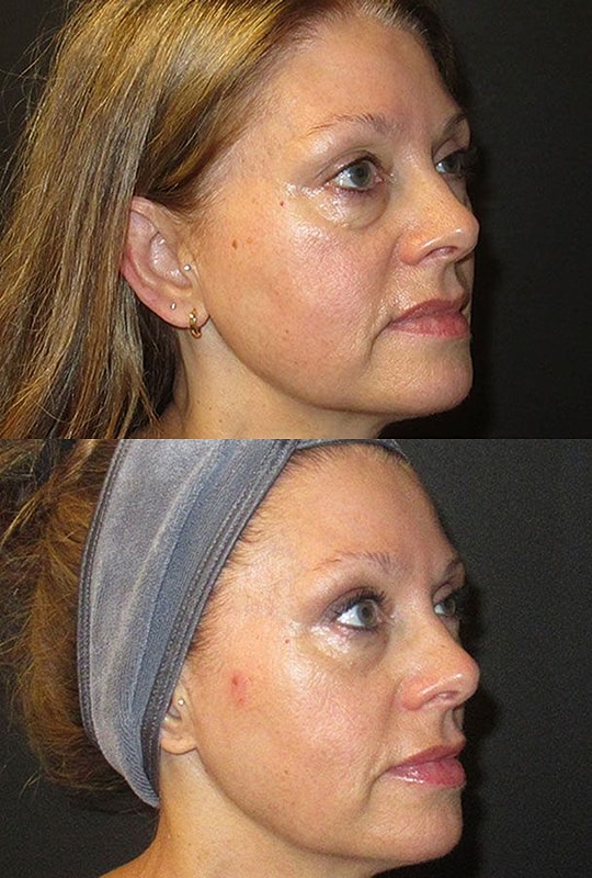 Before and after cosmetic procedure comparison.