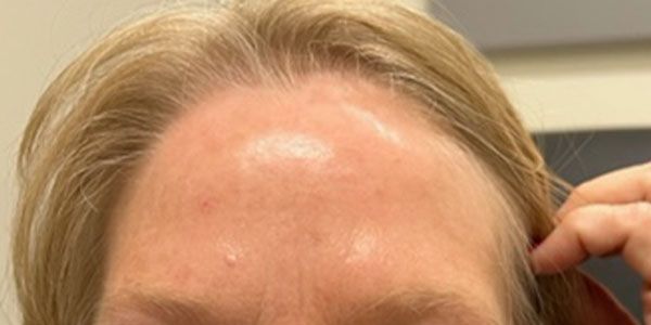 Xeomin Before & After