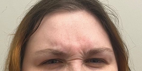 Xeomin Before & After