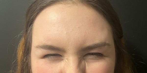 Xeomin Before & After