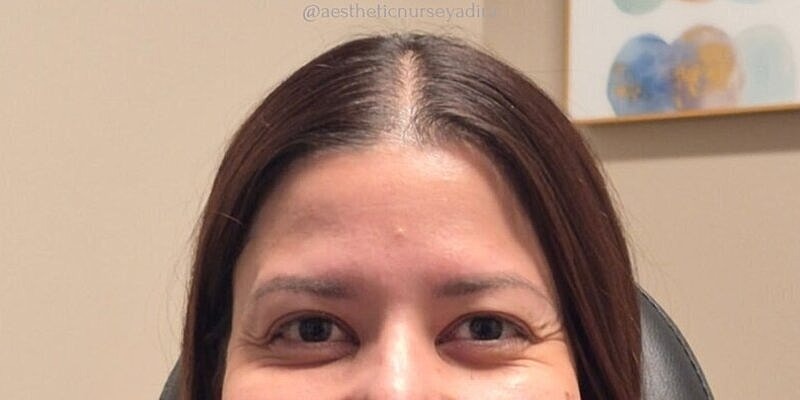 Xeomin Before & After