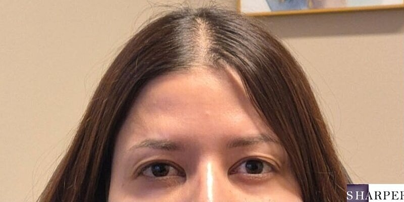 Xeomin Before & After