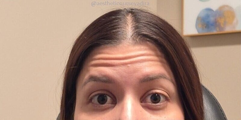 Xeomin Before & After