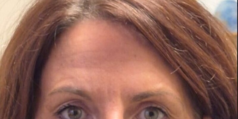 Xeomin Before & After