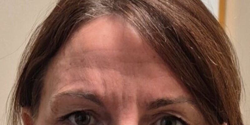 Xeomin Before & After