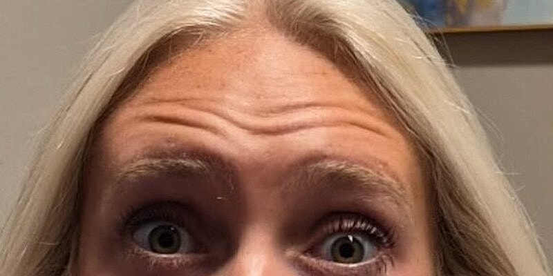 Xeomin Before & After