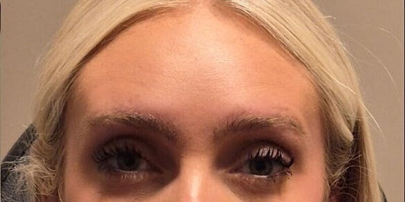 Xeomin Before & After