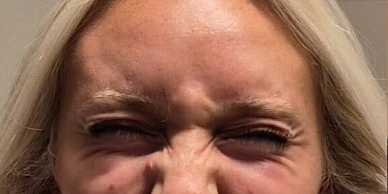 Xeomin Before & After