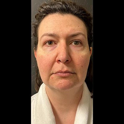 Ultimate Neck Package Before & After