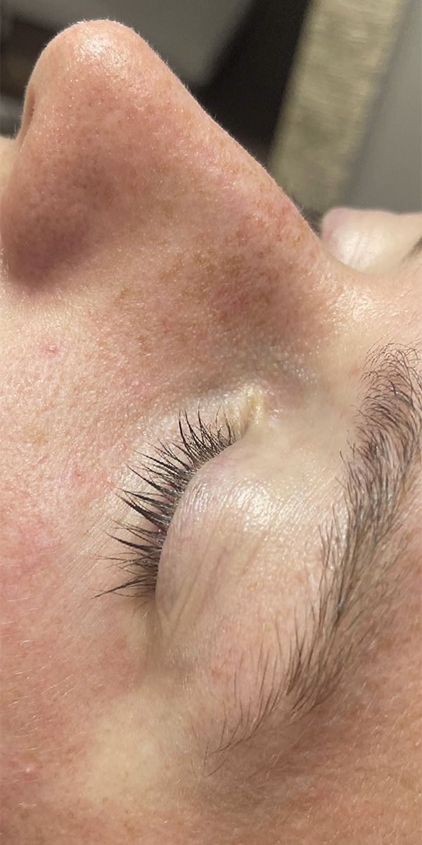 Spider Vein Treatment Before & After