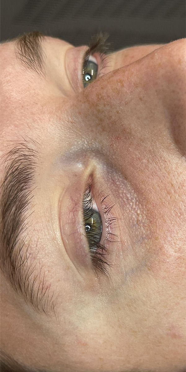 Spider Vein Treatment Before & After