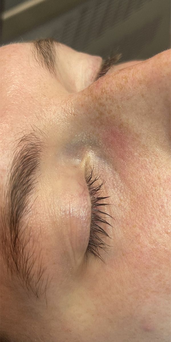 Spider Vein Treatment Before & After