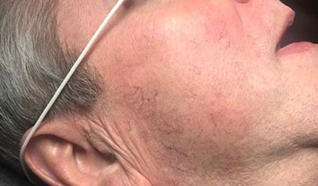 Spider Vein Treatment Before & After