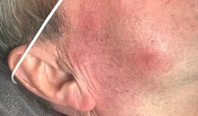 Spider Vein Treatment Before & After