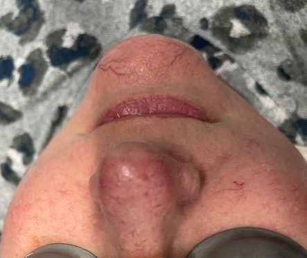 Spider Vein Treatment Before & After