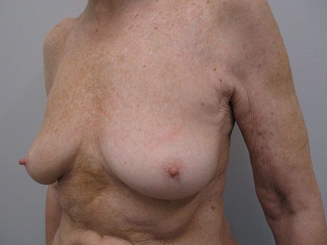 Breast Lift Before & After
