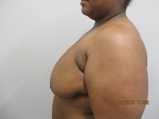 Breast Lift Before & After