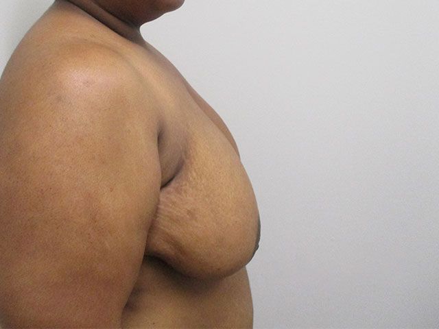 Breast Lift Before & After