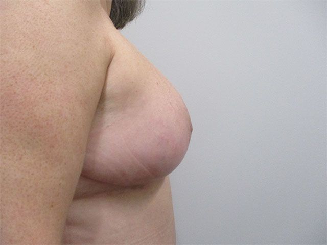 Breast Lift Before & After