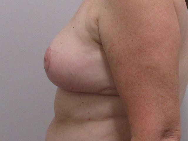 Breast Lift Before & After