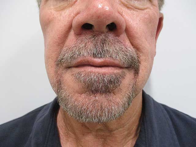 Lower Face Before & After