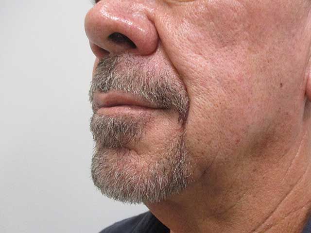 Lower Face Before & After
