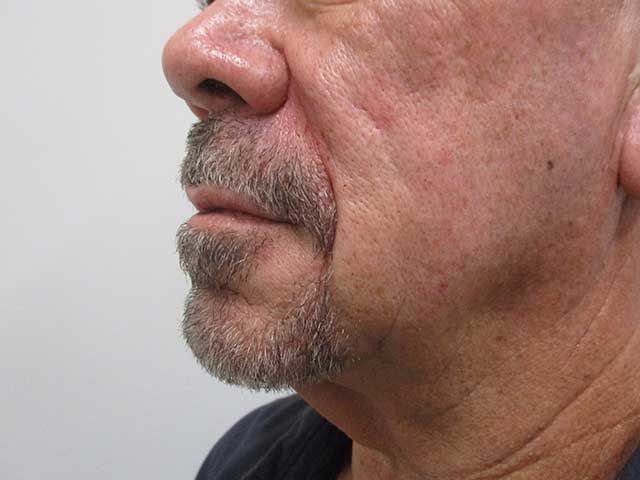 Lower Face Before & After