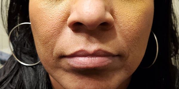 Lower Face Before & After