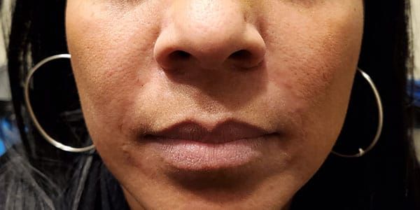 Lower Face Before & After