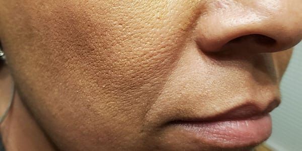 Lower Face Before & After