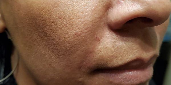 Lower Face Before & After