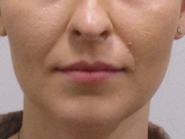 Lower Face Before & After