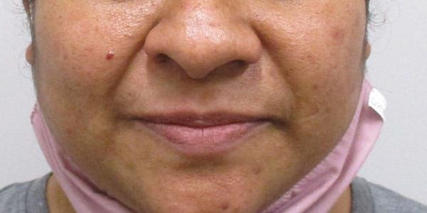 Lower Face Before & After