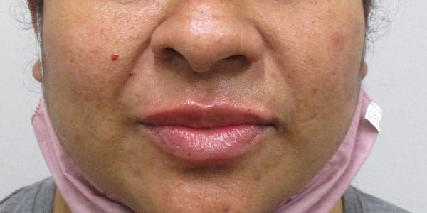 Lower Face Before & After