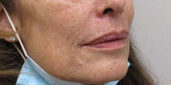 Lower Face Before & After