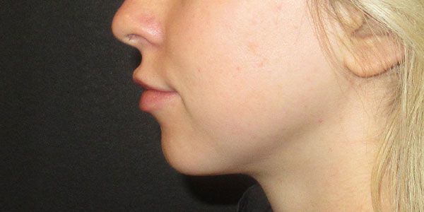 Lower Face Before & After