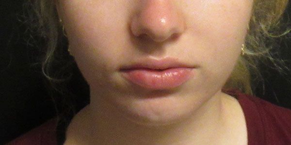 Lower Face Before & After
