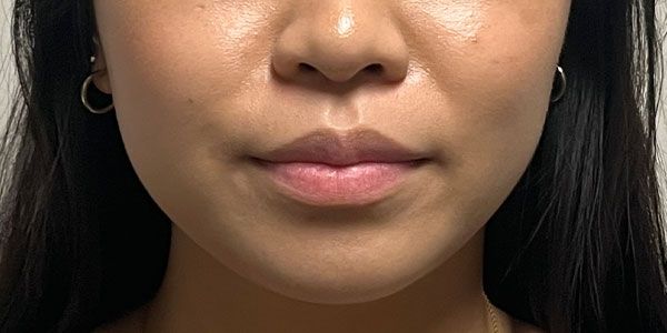 Lower Face Before & After