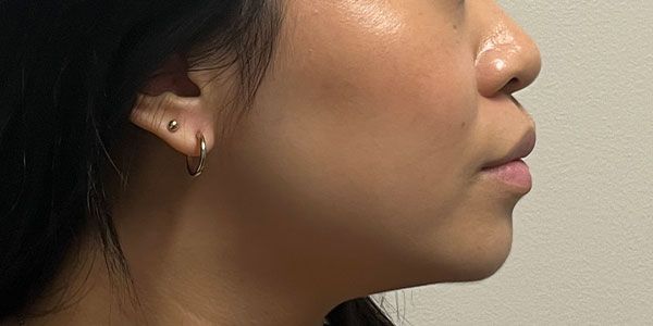 Lower Face Before & After