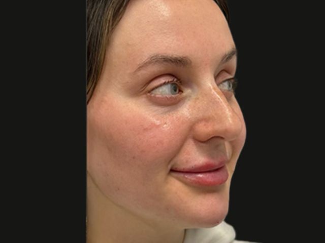 Lower Face Before & After