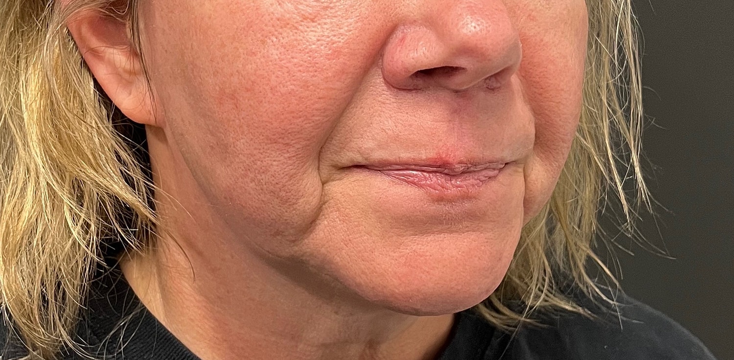 Lower Face Before & After
