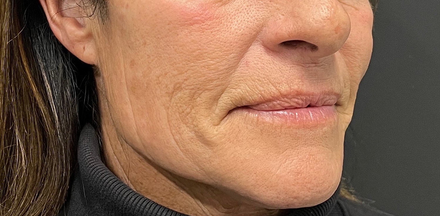 Lower Face Before & After