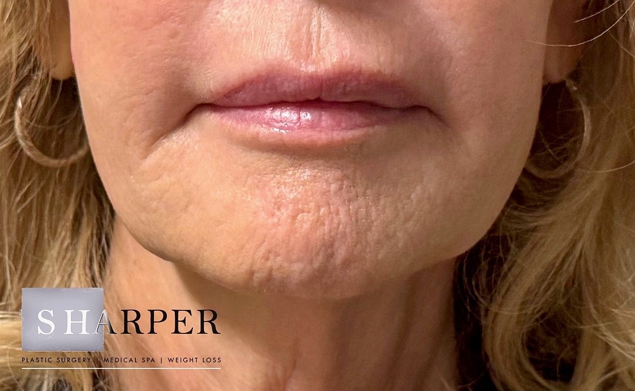 Lower Face Before & After