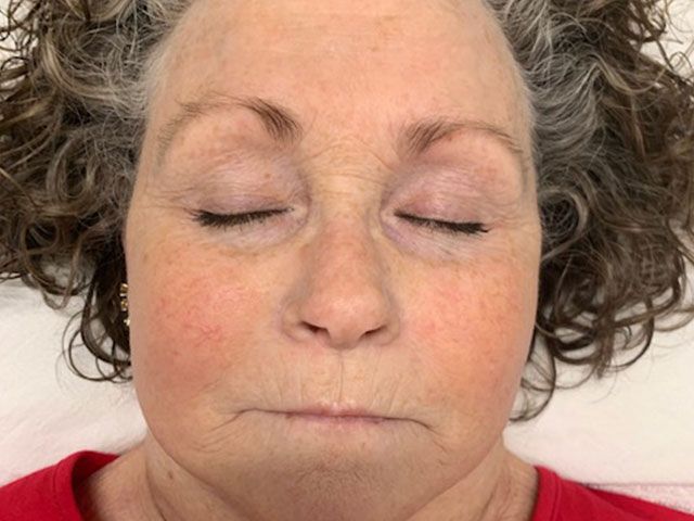 Sun Damage Before & After